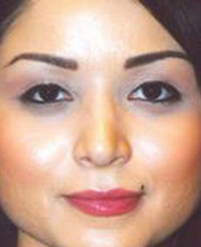 Blepharoplasty Before & After