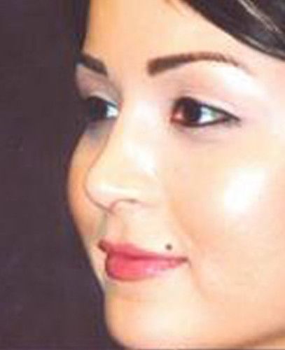 Blepharoplasty Before & After