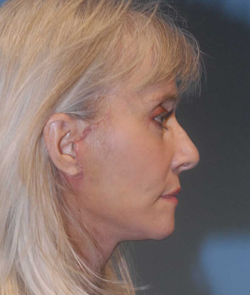 Blepharoplasty Before & After