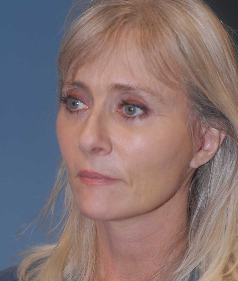 Blepharoplasty Before & After