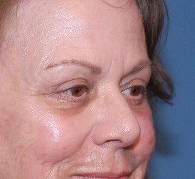 Blepharoplasty Before & After