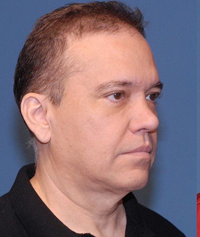 Blepharoplasty Before & After