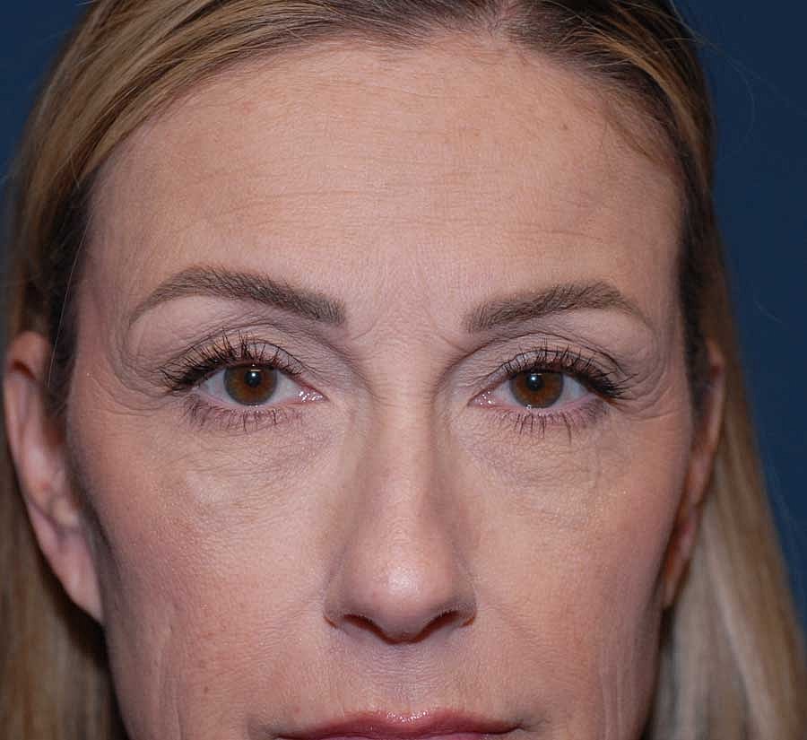 Blepharoplasty Before & After
