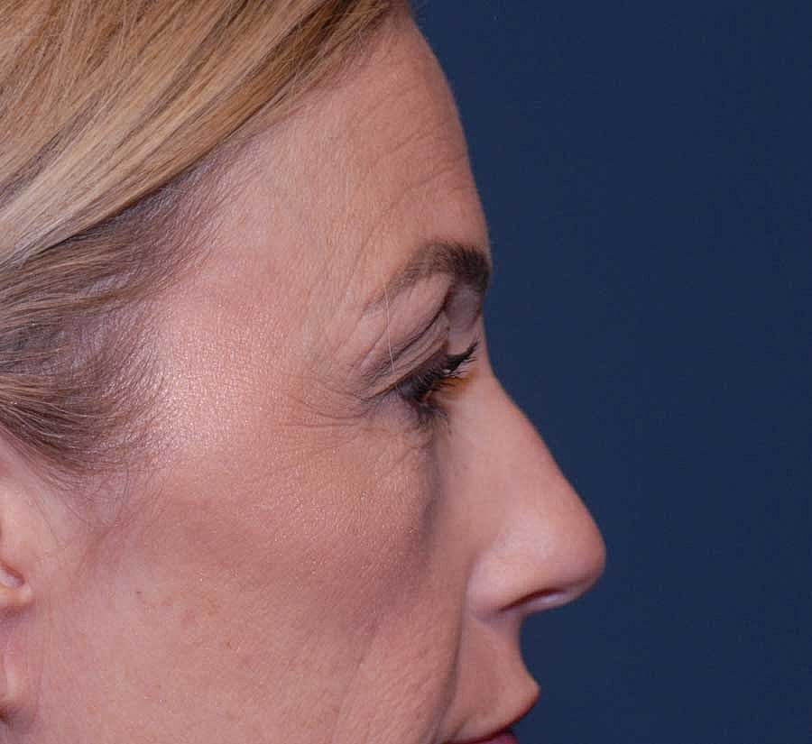 Blepharoplasty Before & After