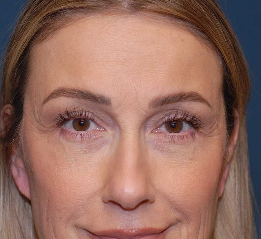 Blepharoplasty Before & After