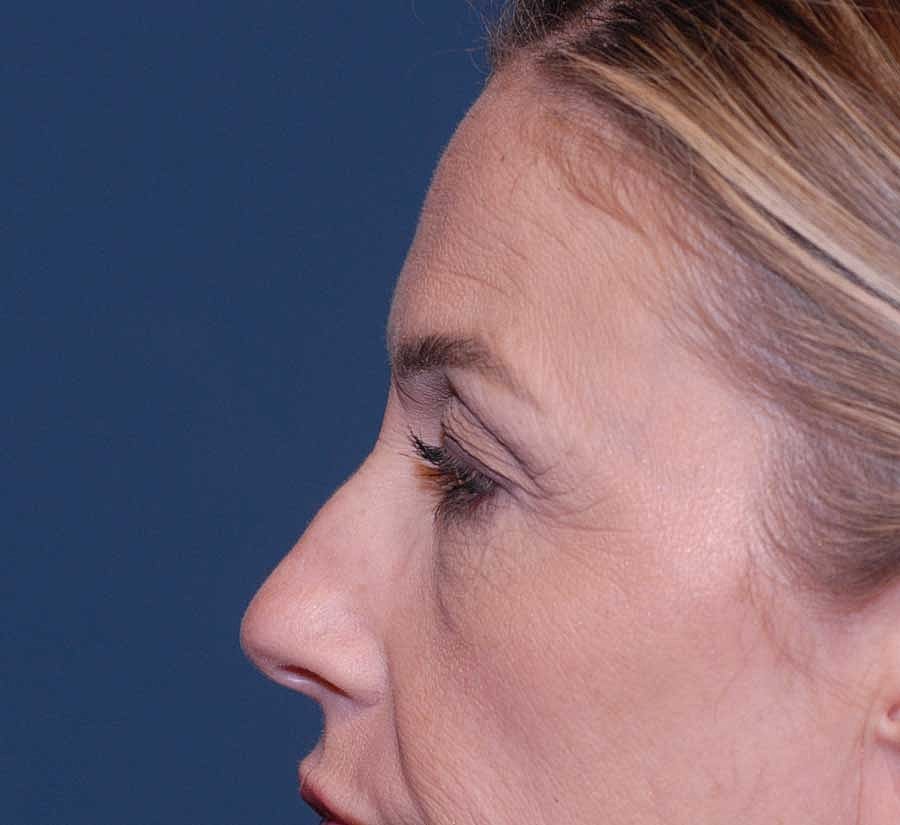 Blepharoplasty Before & After