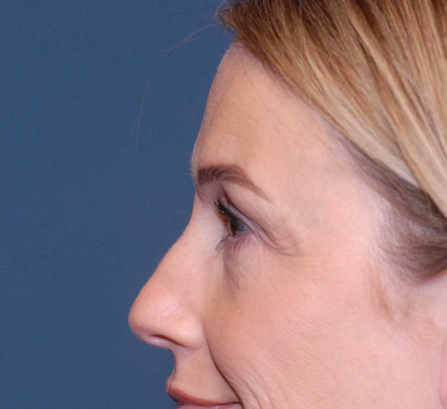Blepharoplasty Before & After