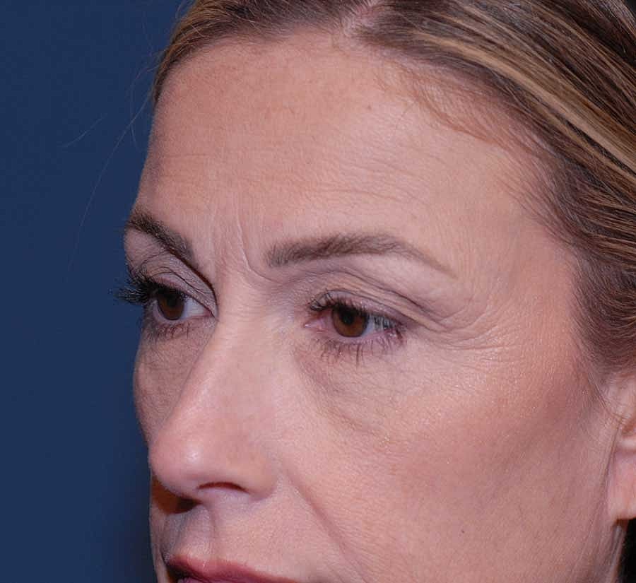 Blepharoplasty Before & After