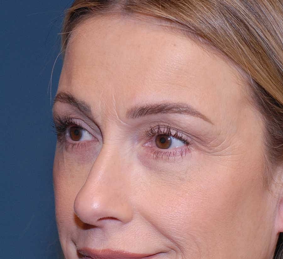 Blepharoplasty Before & After