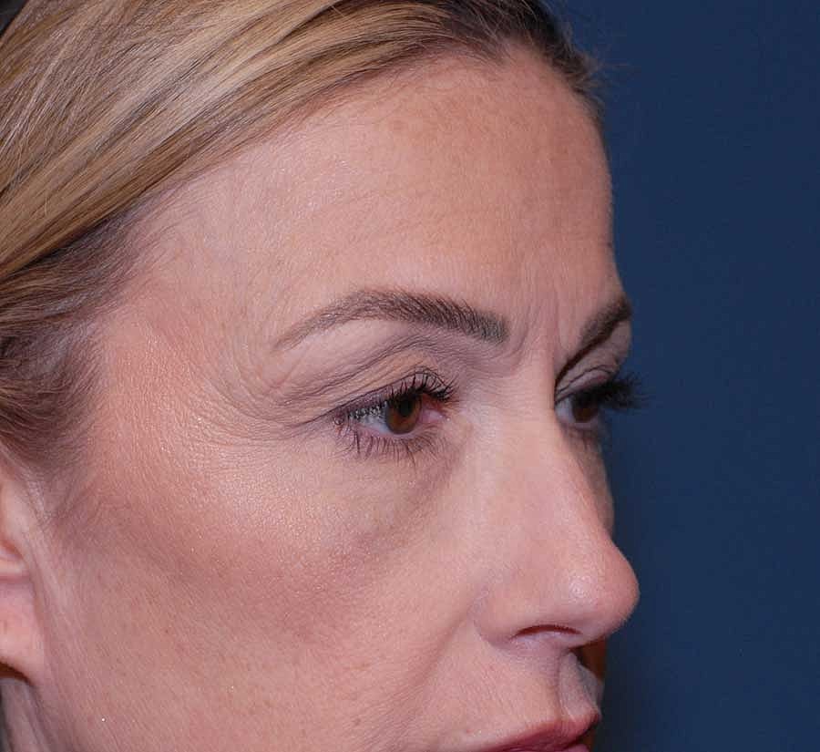 Blepharoplasty Before & After