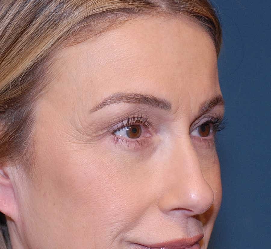 Blepharoplasty Before & After