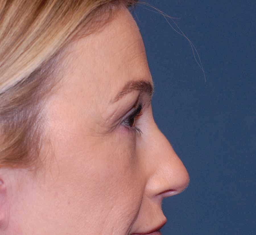 Blepharoplasty Before & After