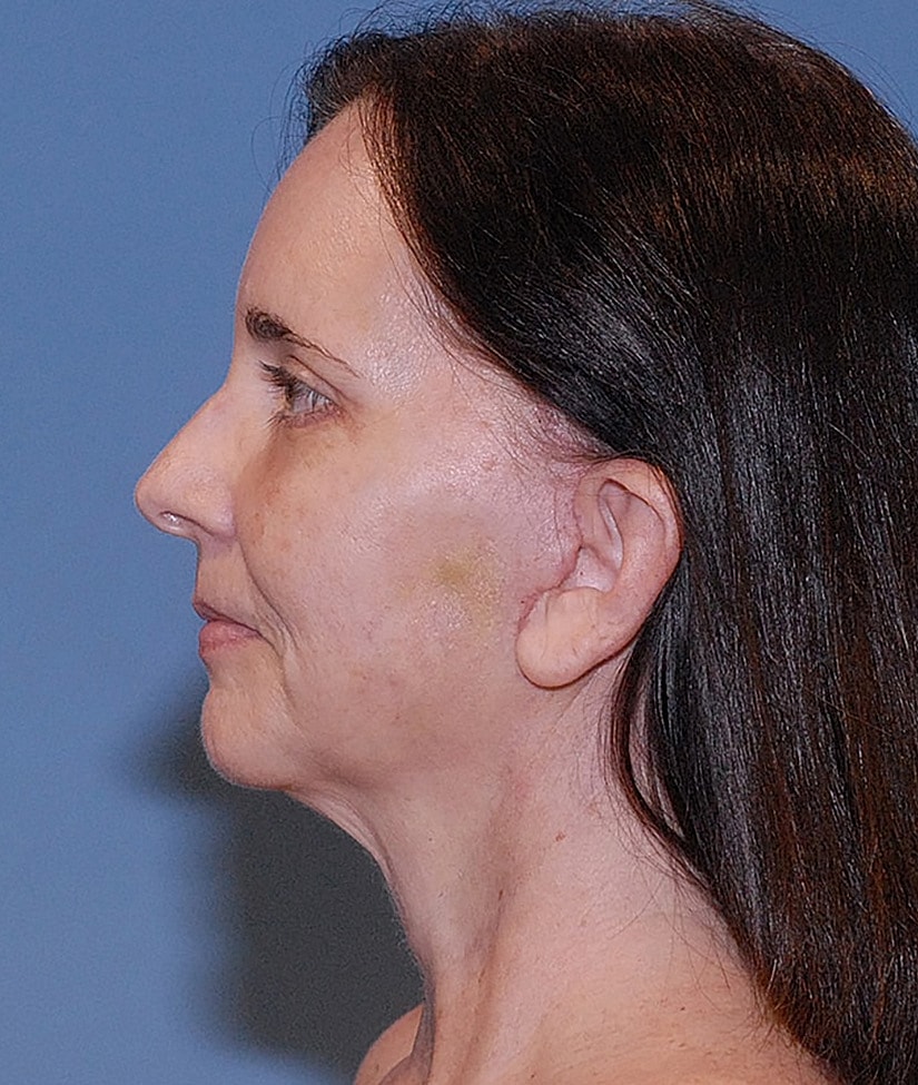 Blepharoplasty Before & After