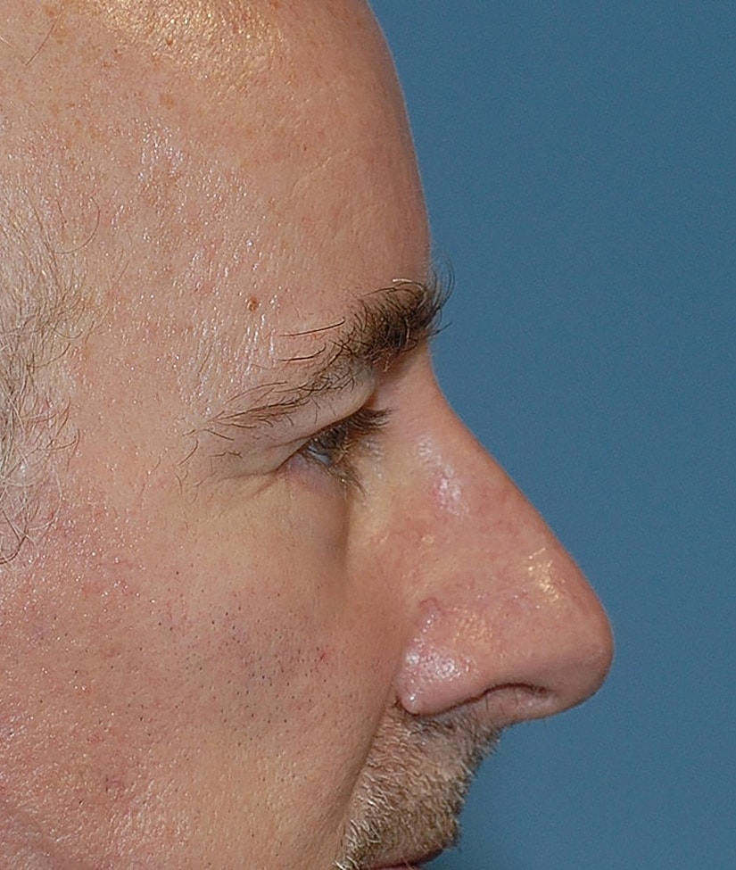 Blepharoplasty Before & After