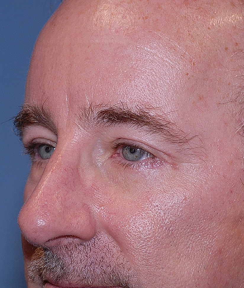 Blepharoplasty Before & After