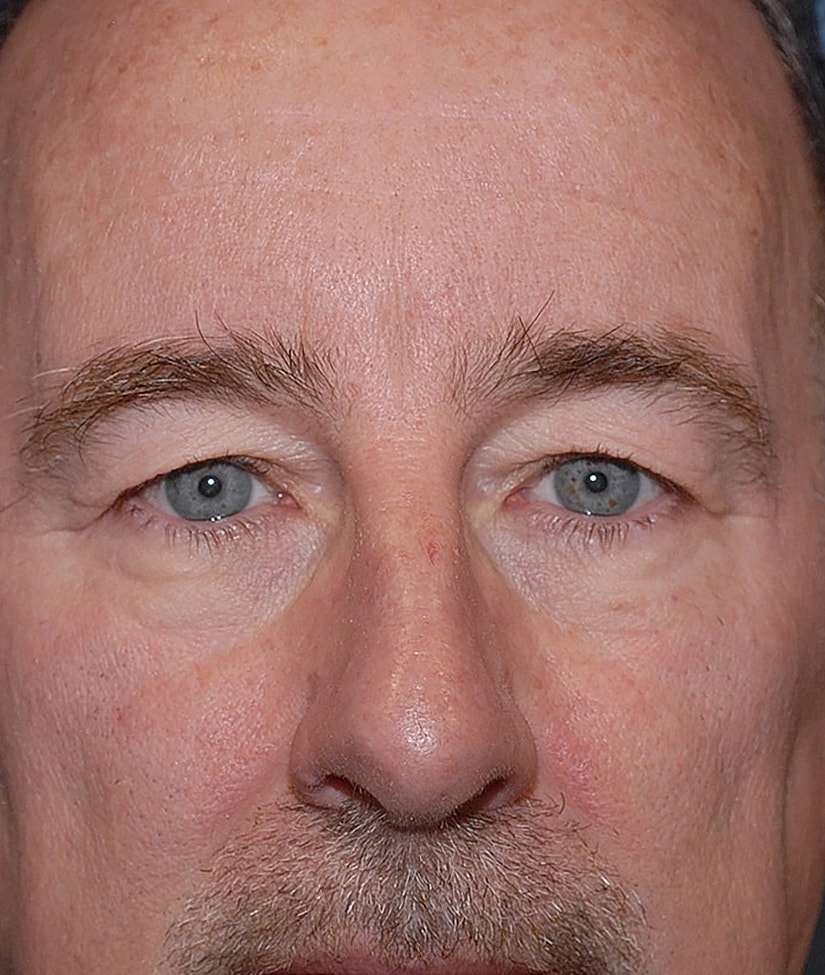 Blepharoplasty Before & After