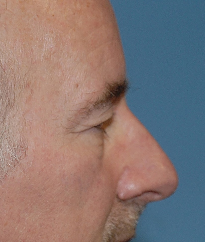 Blepharoplasty Before & After