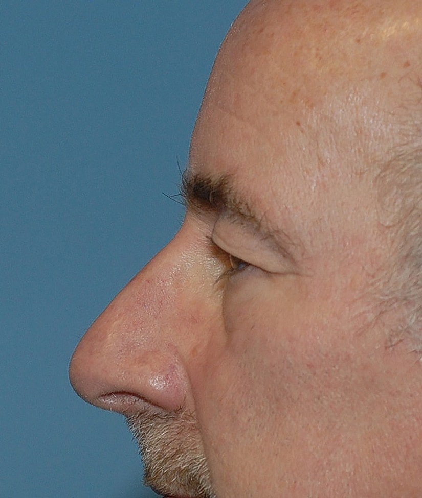 Blepharoplasty Before & After