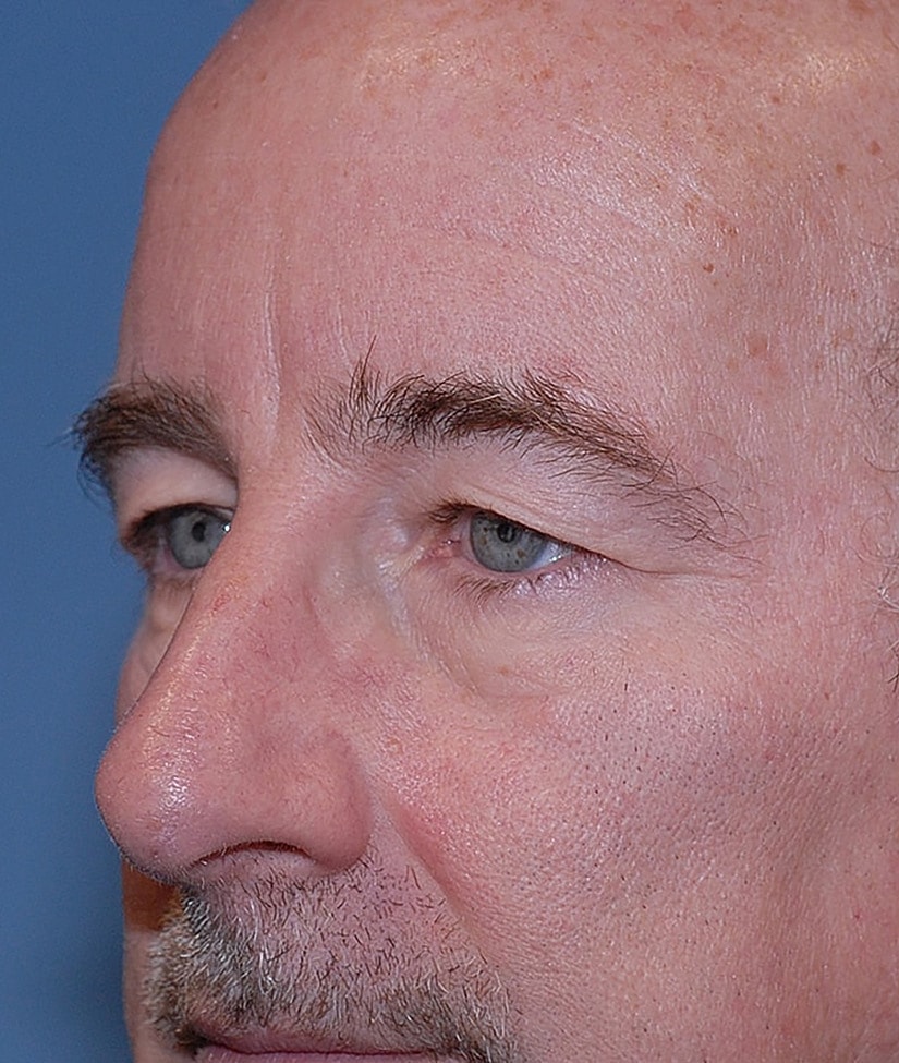 Blepharoplasty Before & After