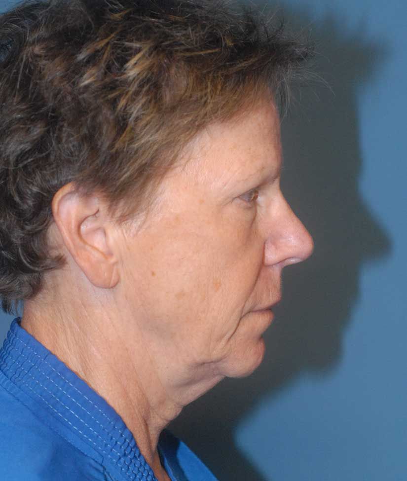 Fat Grafting Before & After