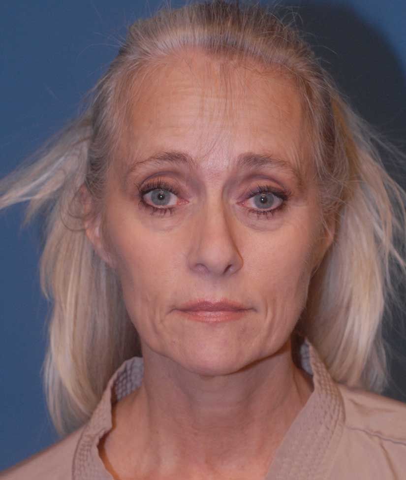 Fat Grafting Before & After