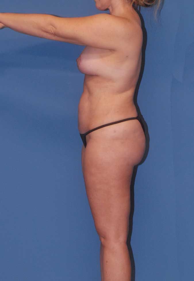 Thigh Lift Before & After