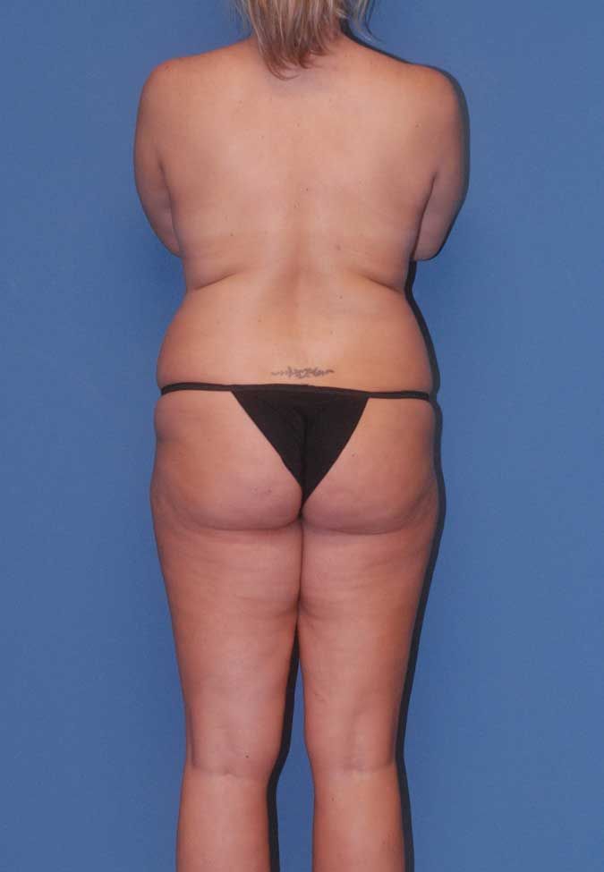 Thigh Lift Before & After