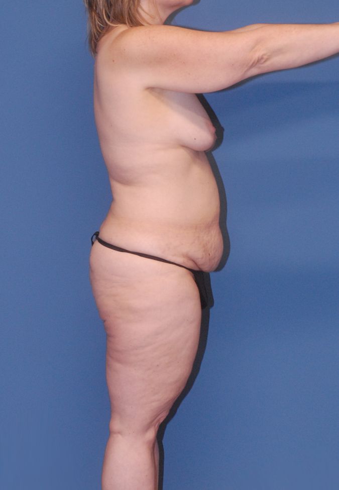 Thigh Lift Before & After