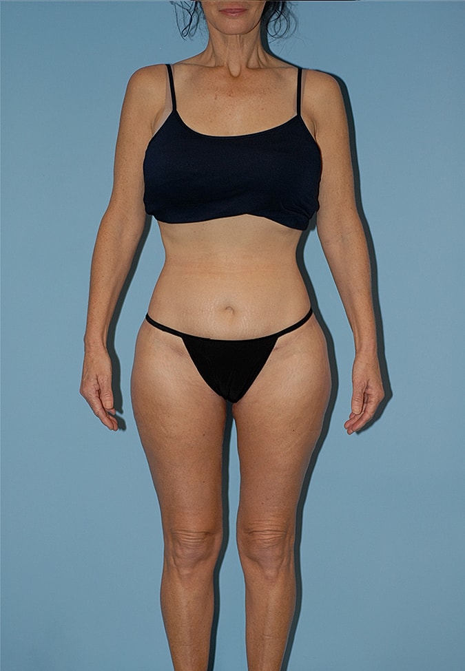 Thigh Lift Before & After