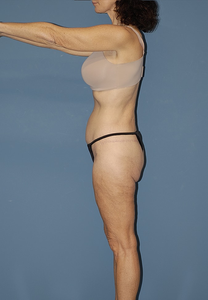 Thigh Lift Before & After
