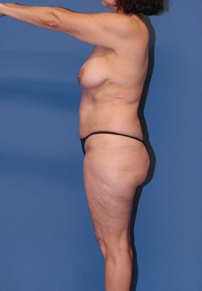 Lower Body Lift And Back Lift Before & After