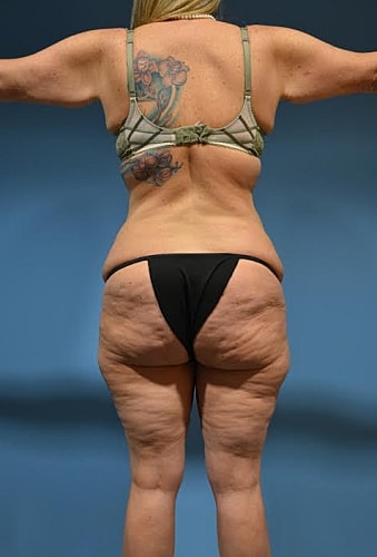 Post Weight Loss Surgery Before & After