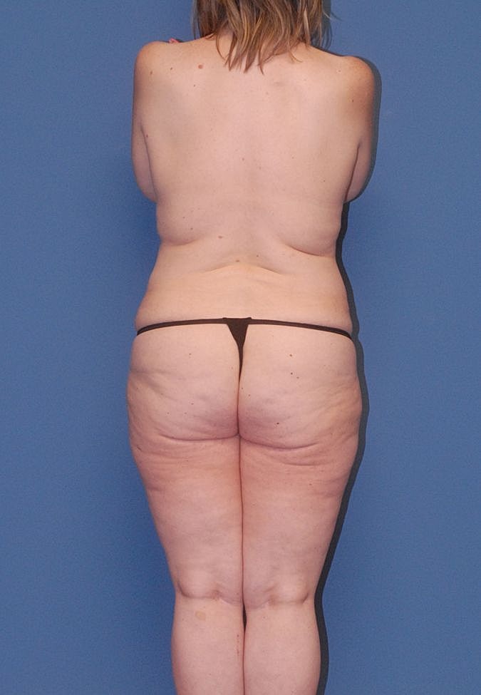 Post Weight Loss Surgery Before & After