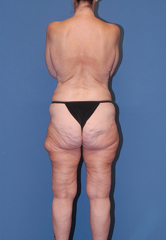 Post Weight Loss Surgery Before & After