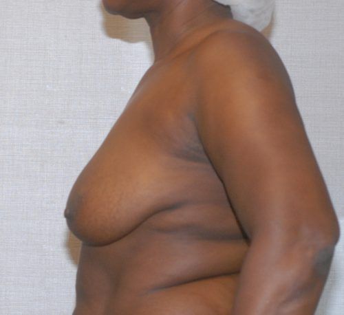 Breast Lift Before & After