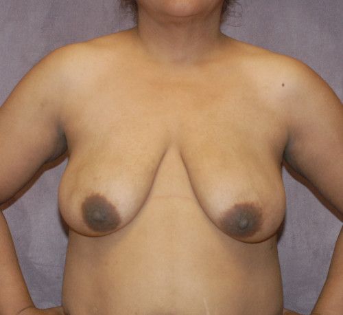 Breast Lift Before & After