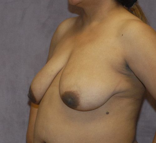 Breast Lift Before & After