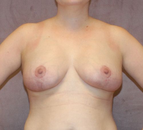 Breast Lift Before & After
