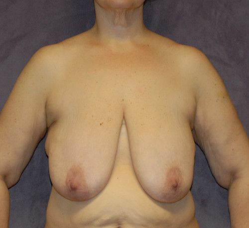 Breast Lift Before & After
