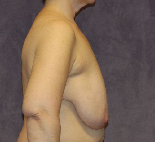 Breast Lift Before & After