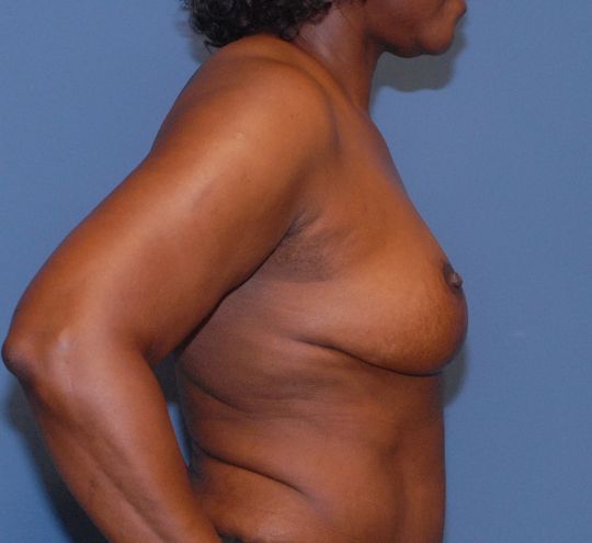 Breast Lift Before & After