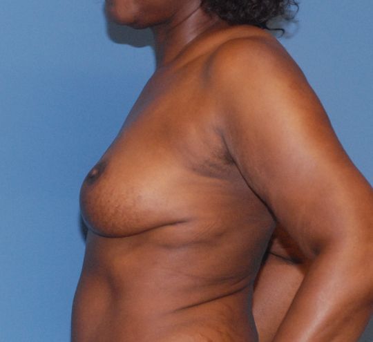 Breast Lift Before & After