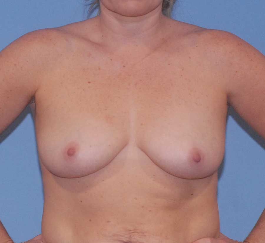 Breast Lift Before & After