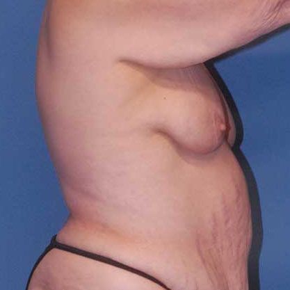 Breast Lift Before & After