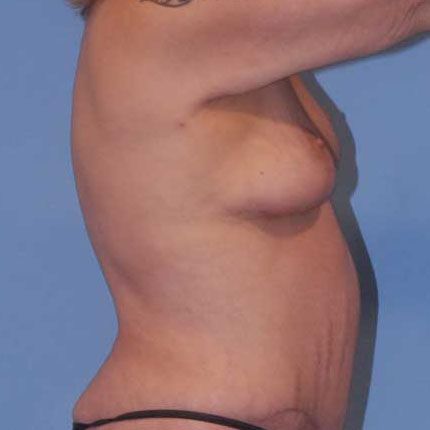 Breast Lift Before & After