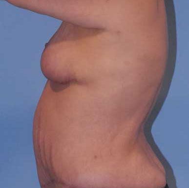 Breast Lift Before & After