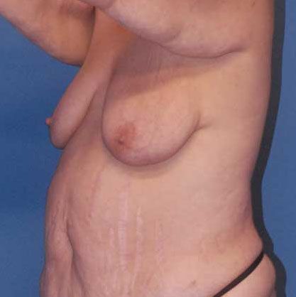 Breast Lift Before & After