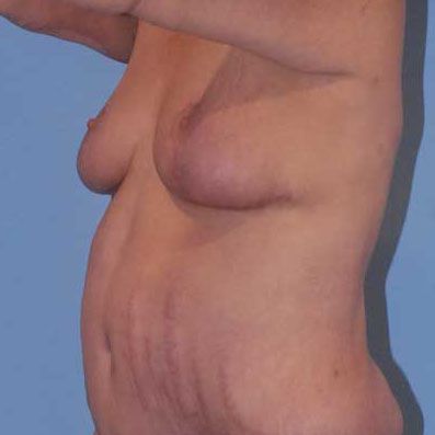 Breast Lift Before & After