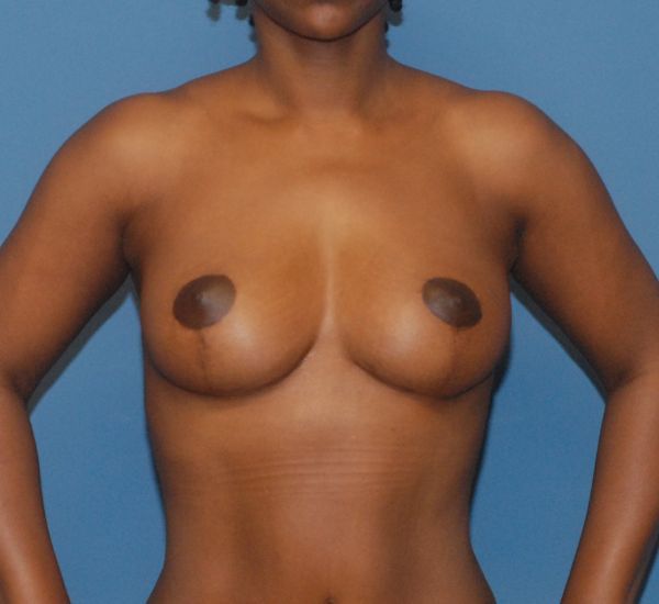 Breast Lift Before & After