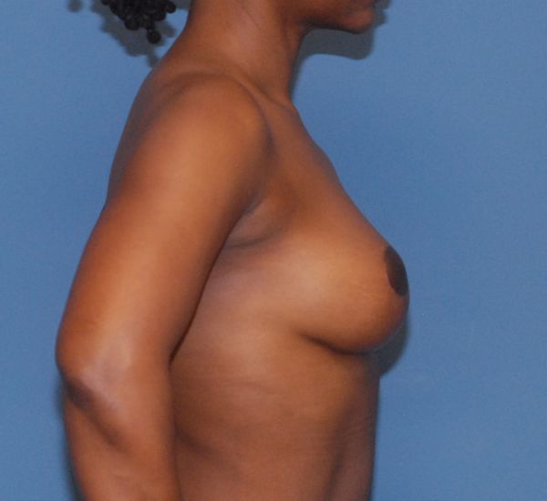 Breast Lift Before & After